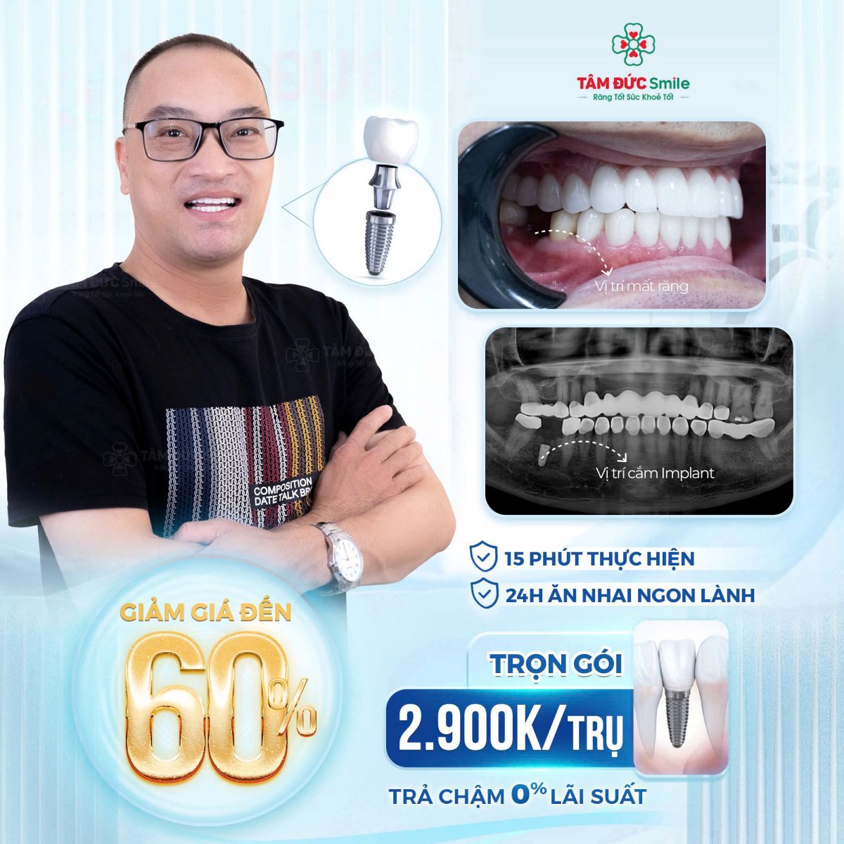 ưu đãi trồng răng tại nha khoa tâm đức smile