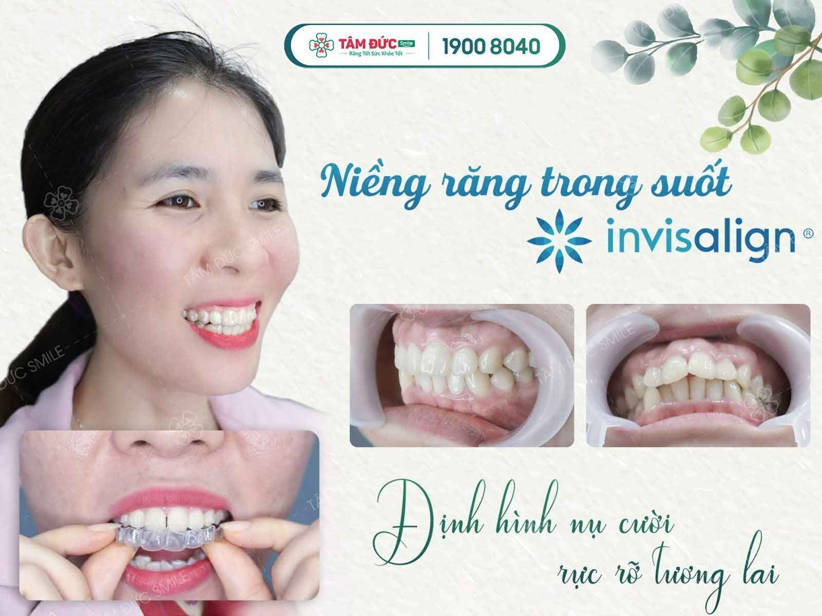 giải pháp làm răng sứ cho người bị hô