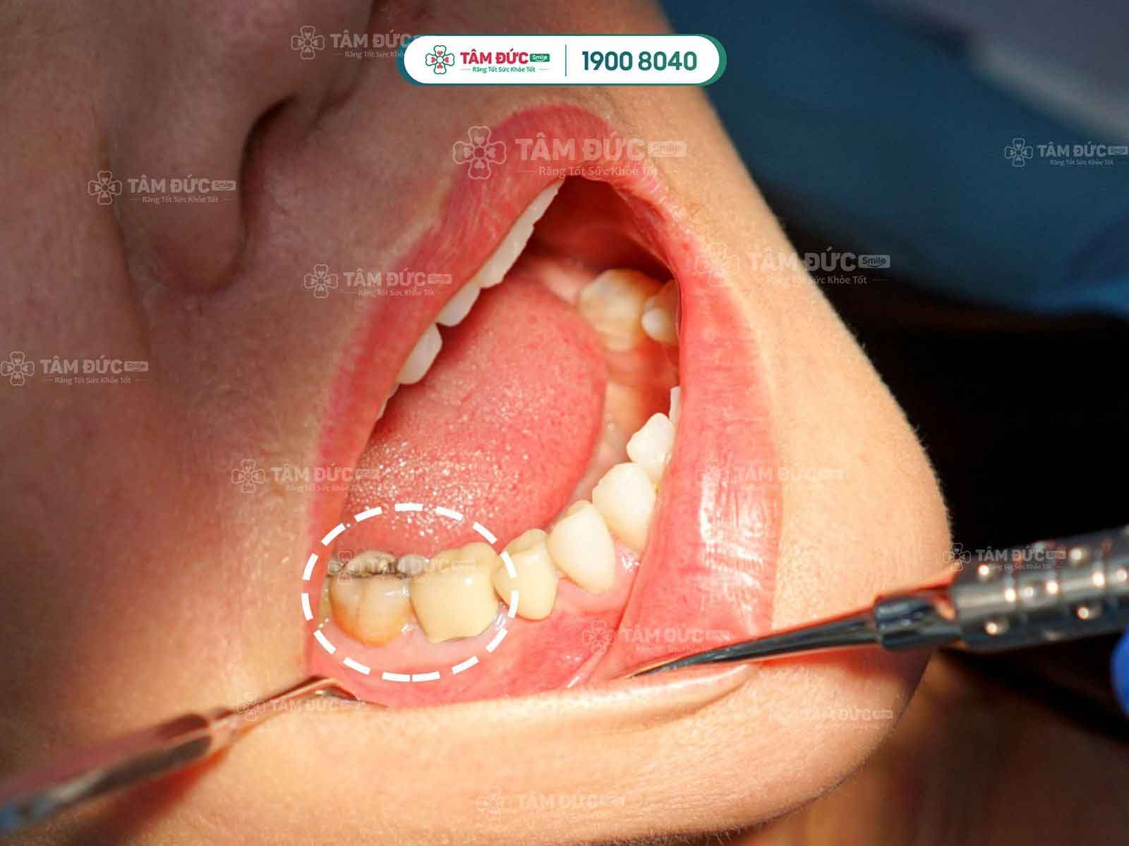 răng hàm sâu và bị hoại tử tuỷ